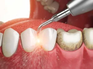 اطلاعات جرمگیری و کورتاژ دندان ها
