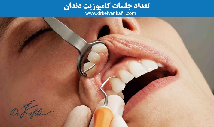 مدت زمان انجام کامپوزیت برای هر دندان