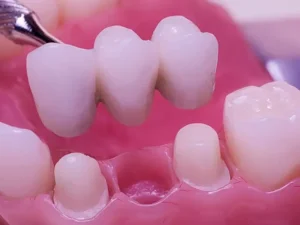 ملاحظات مهم در ارتباط با پروتزهای ثابت