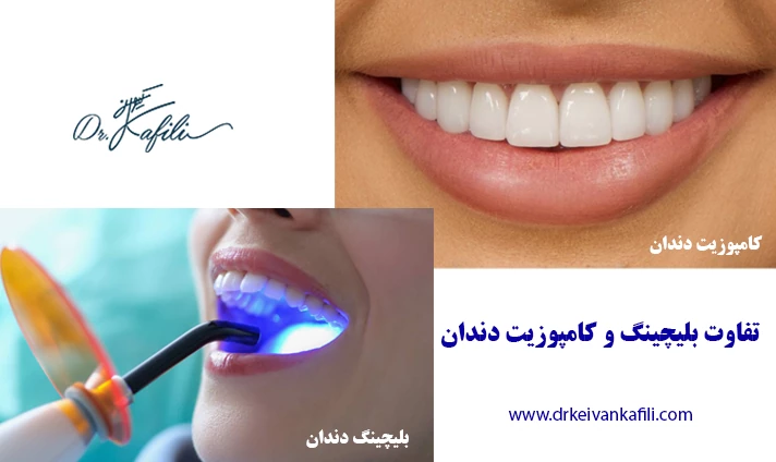 تفاوت بلیچینگ و کامپوزیت دندان