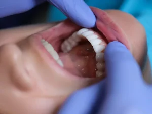 کامپوزیت دندان بهتر است یا بلیچینگ؟