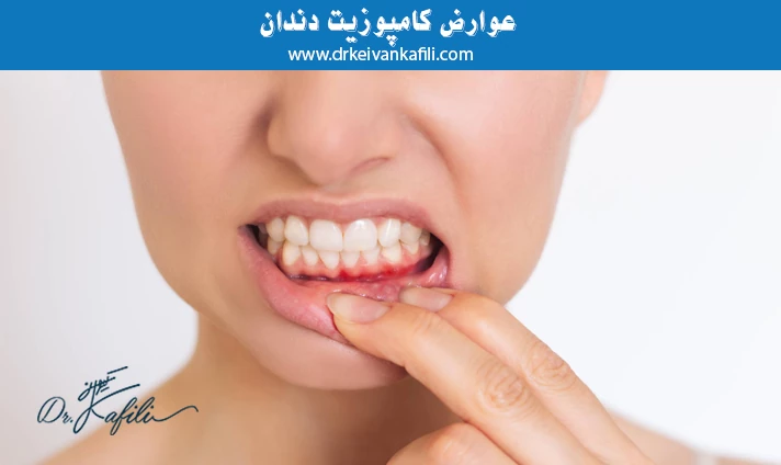 عوارض کامپوزیت دندان