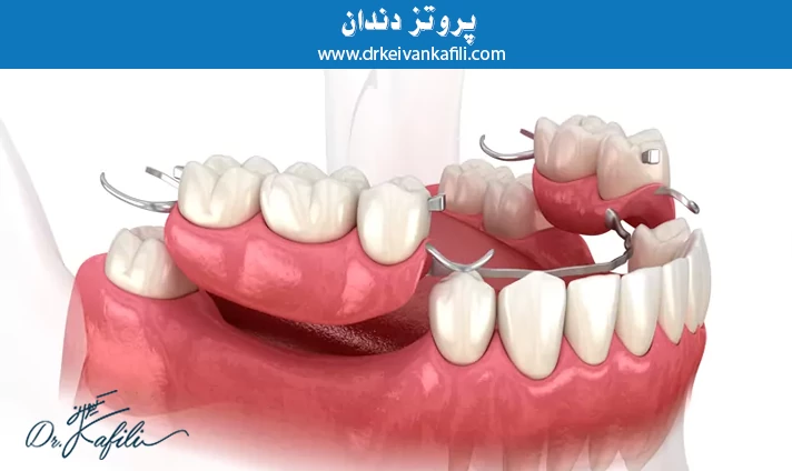 پروتز دندان