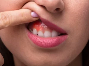 پیشگیری از عوارض کامپوزیت دندان